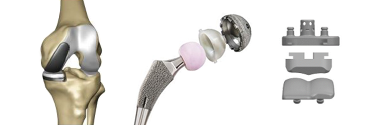 Recomendaciones para el seguimiento de pacientes implantados con determinadas prótesis de Exactech por un posible desgaste prematuro