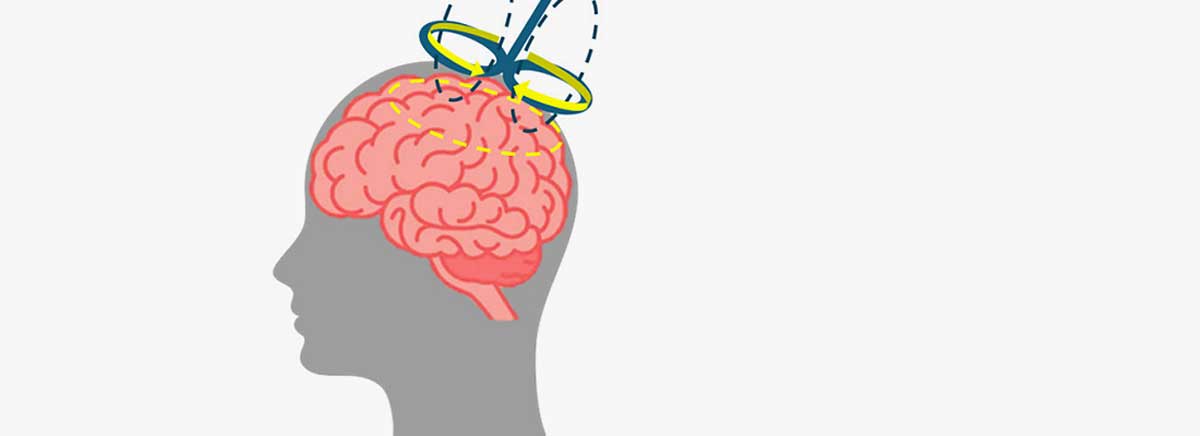 ilustracion de estimulador cerebral